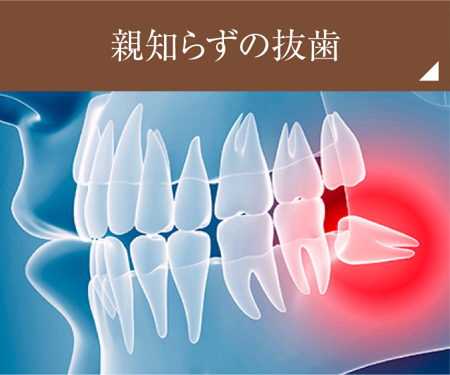親知らずの抜歯