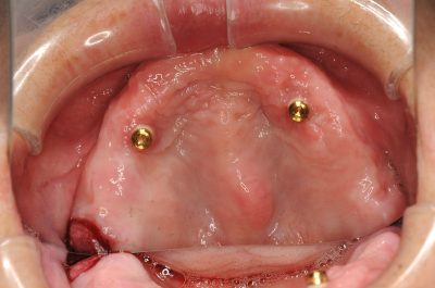 入れ歯が合わない方は八潮市の歯医者「BiVi歯科・矯正歯科」へご相談ください