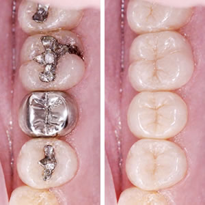 歯を削らない治療