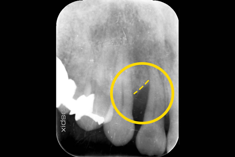 重症化した歯周病を手術なしで治療した症例