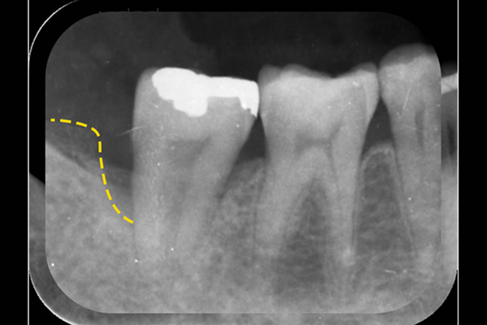 前歯の再生療法と精密根管治療で歯を保存した症例
