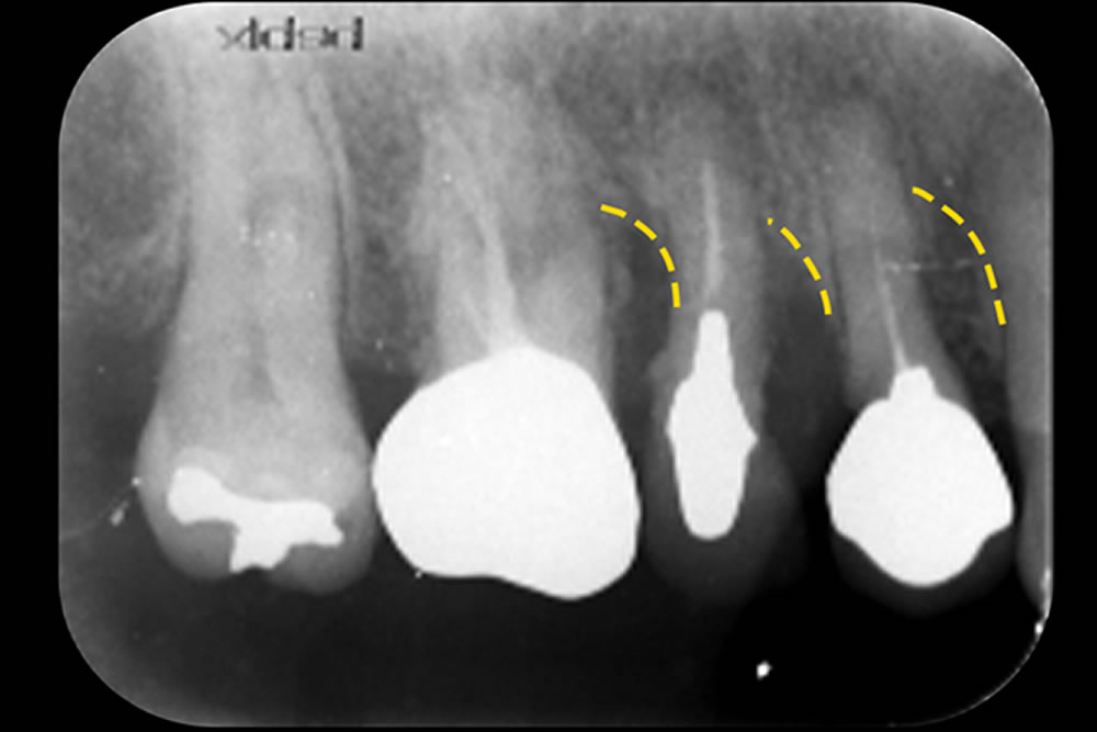 前歯の歯周病を手術しないで治した症例