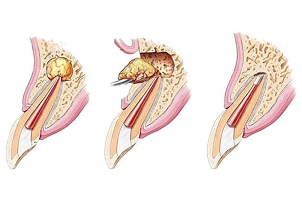 歯根端切除術や歯の再植術に対応