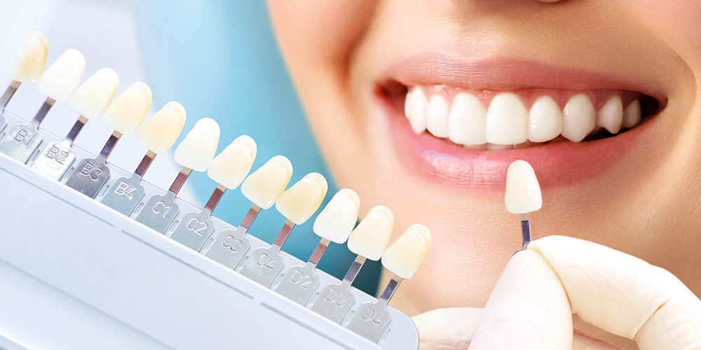 ホームホワイトニング