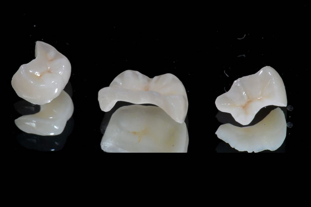 セラミックインレー