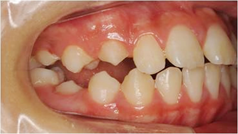 小児矯正開咬症例