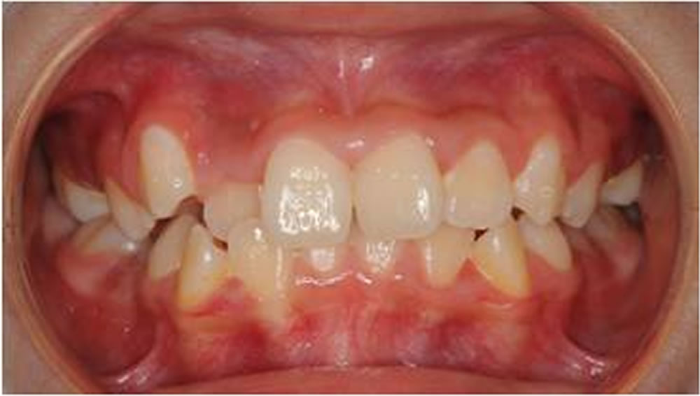 小児矯正開咬症例