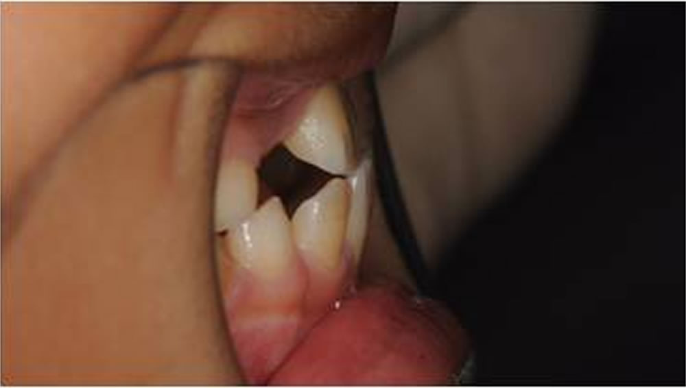 小児矯正乱ぐい歯症例