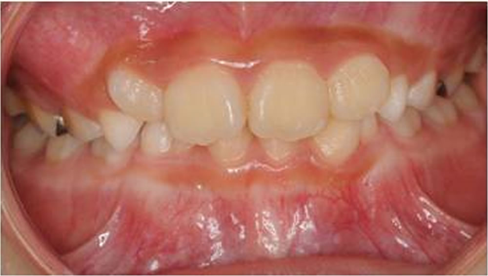 小児矯正開咬症例