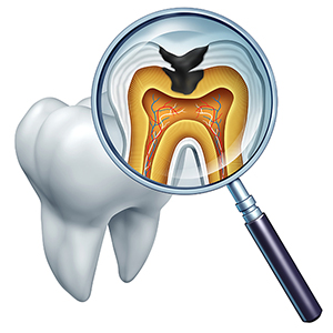 痛くない虫歯治療