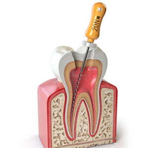 精密・根管(神経)治療