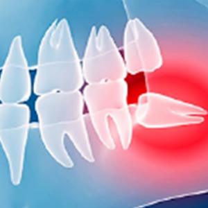 痛くない親知らず抜歯