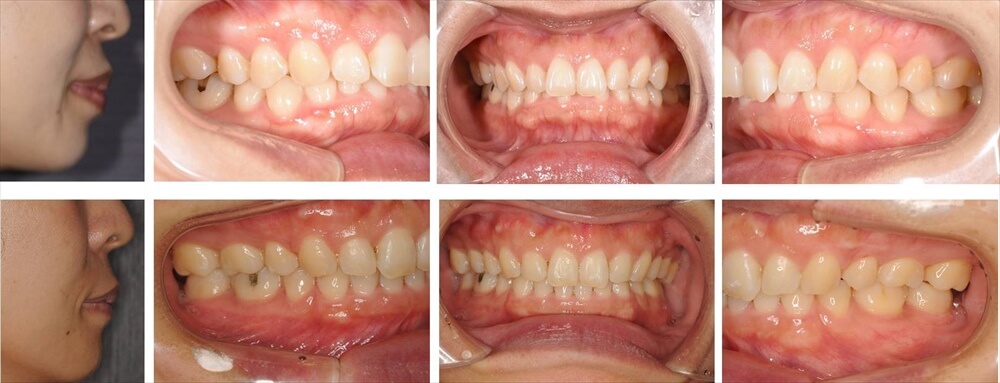 過蓋咬合(咬み合わせが深い)の大人の矯正治療例