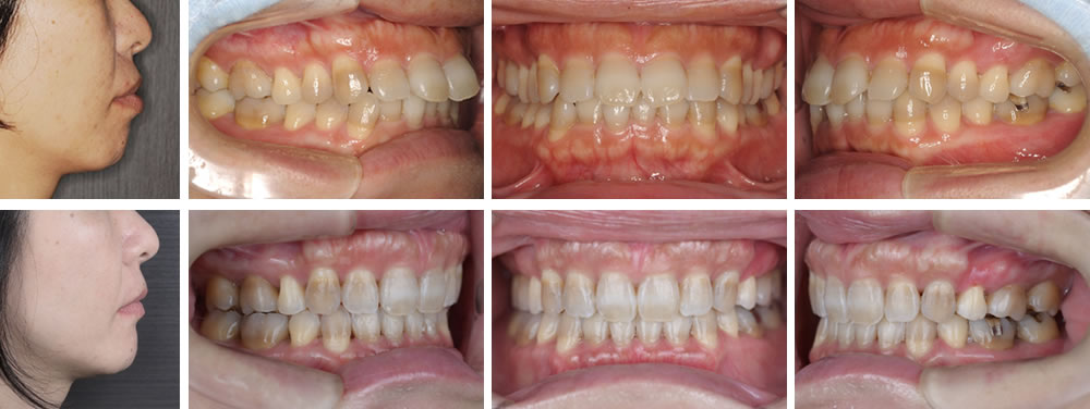 上顎前突(出っ歯)の大人の矯正治療例