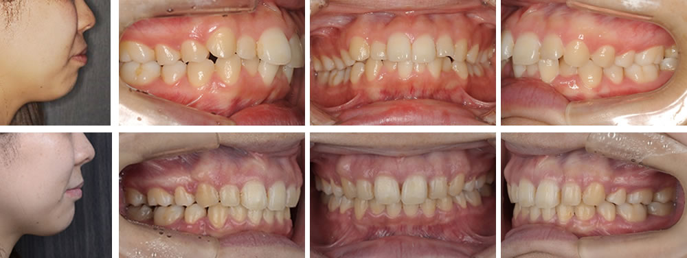 開咬歯列の大人の矯正治療例