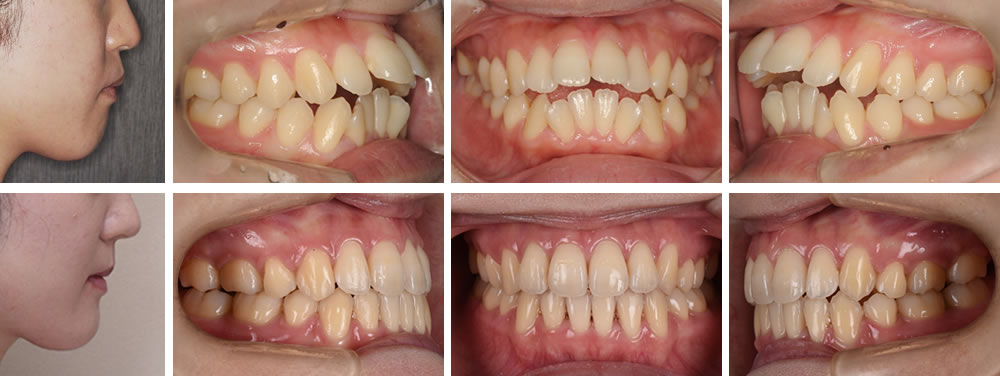 開咬歯列の大人の矯正治療例