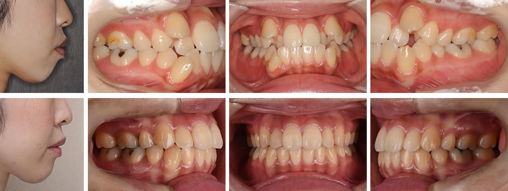 叢生(デコボコ歯列)の大人の矯正治療例