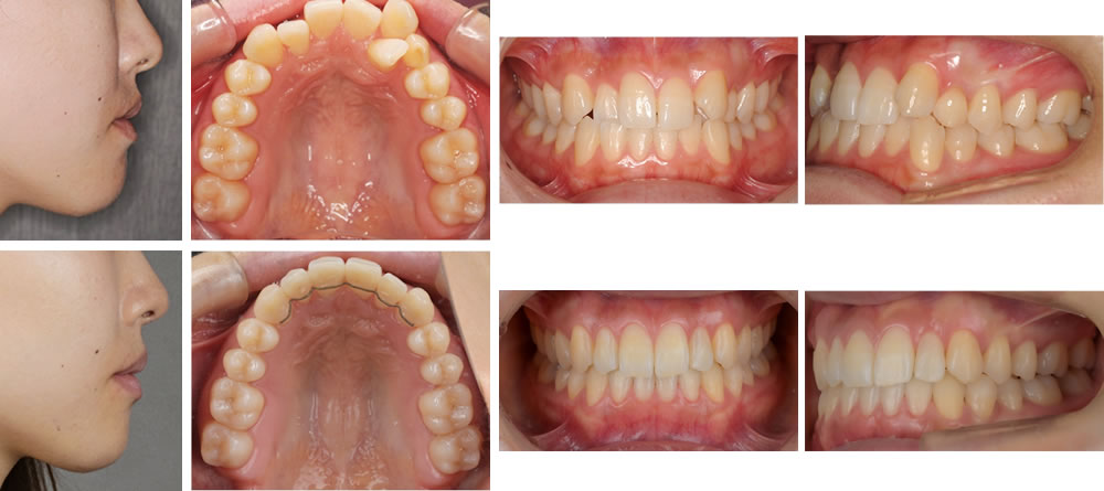 叢生(デコボコ歯列)の大人の矯正治療例