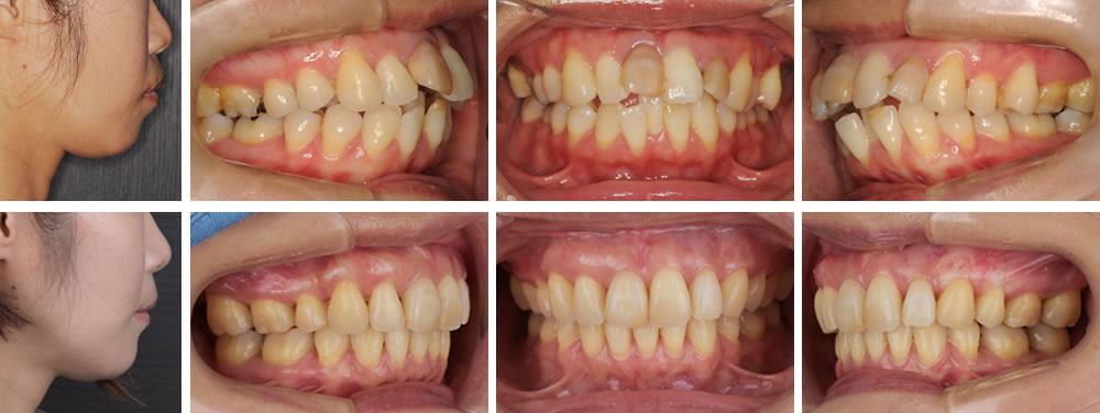 叢生(デコボコ歯列)の大人の矯正治療例