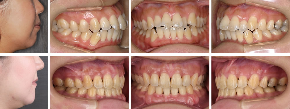 開咬歯列の大人の矯正治療例