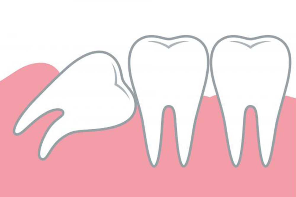 親知らずが手前の歯を押している