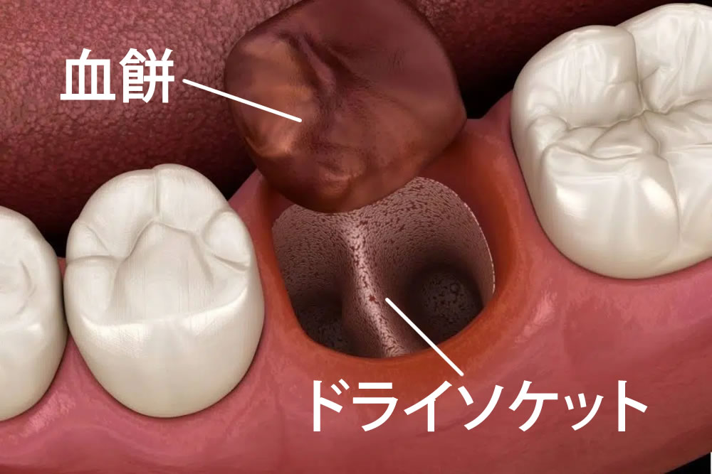 ドライソケット