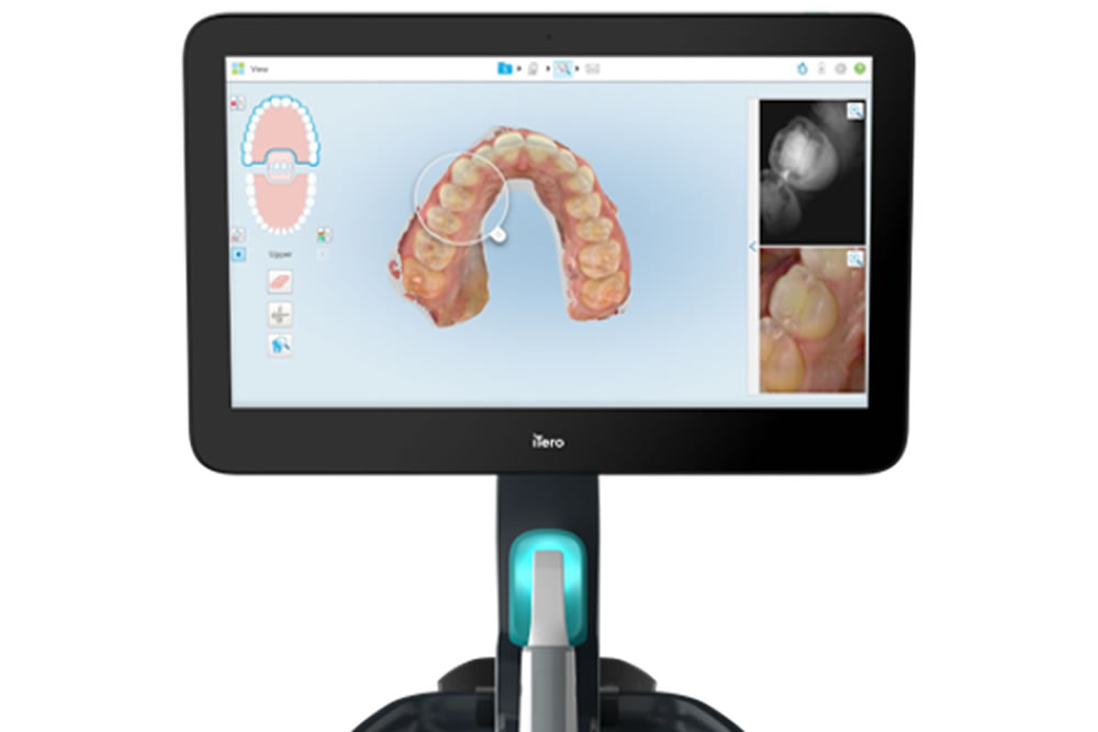 3D光学スキャナー(iTeroエレメント5DPlus)